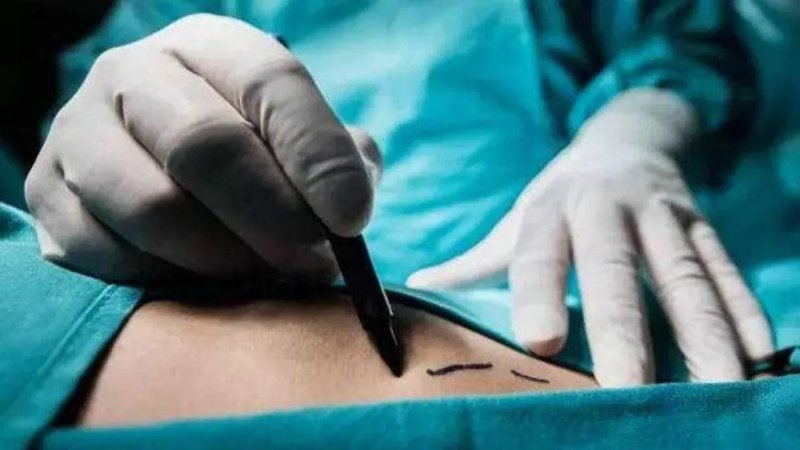Estetik Ameliyat Korkusu: İtalyan Kadın Hayatını Kaybetmekten Döndü