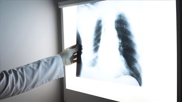 Tütün Kullanımı Akciğer Kanseri Riskini 20 Kata Kadar Artırıyor