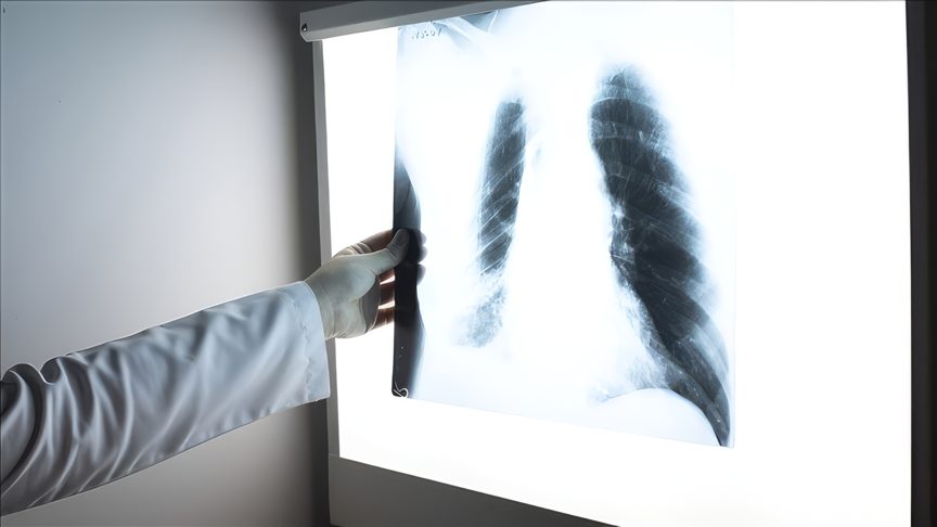 Tütün Kullanımı Akciğer Kanseri Riskini 20 Kata Kadar Artırıyor