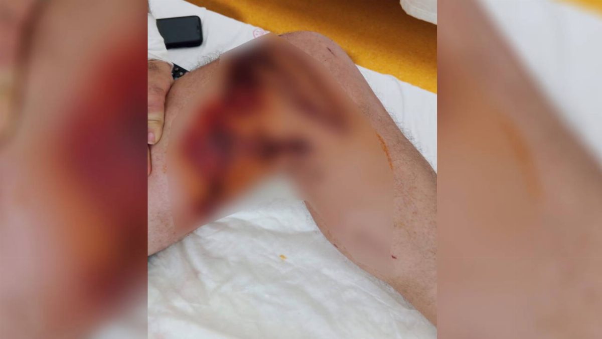Başakşehir'de lavabo açıcı vücuda döküldü, yanıklar oluştu