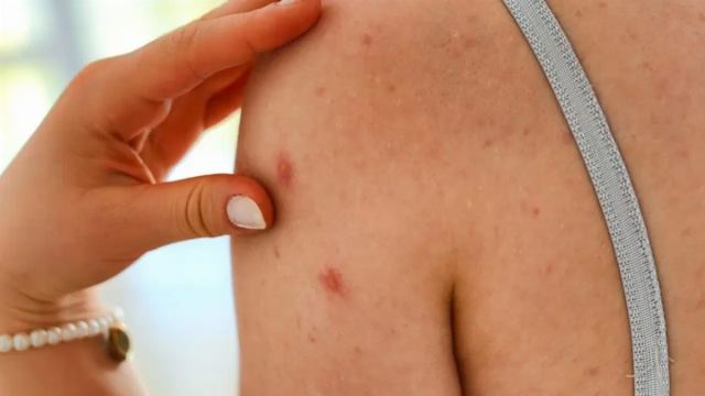 Zona Hastalığına Bağlı Kronik Ağrının Mekanizması Çözüldü