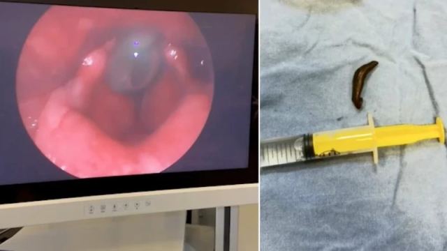 10 yaşındaki çocuk, burun kanaması nedeniyle hastaneye kaldırıldı