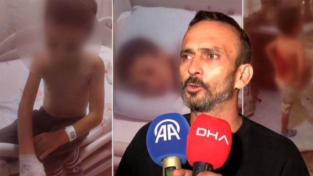 Arnavutköy'de çocuk, arkadaşları tarafından yakıldı