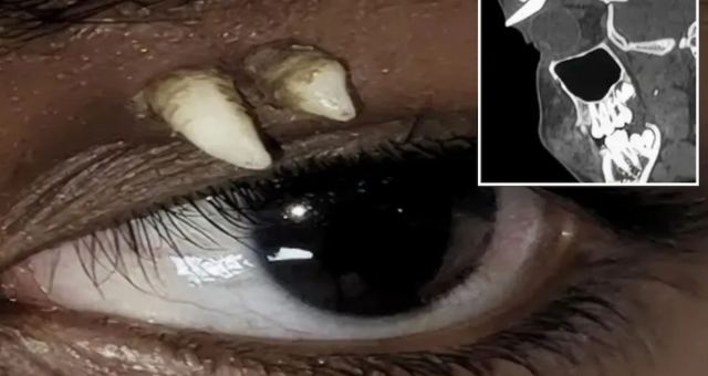 Madurai'de 16 yaşındaki çocuğun gözünde diş bulundu