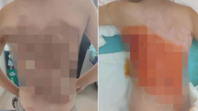 Arnavutköy'de Akran Zorbalığı: 12 Yaşındaki Çocuğun Sırtı Yandı