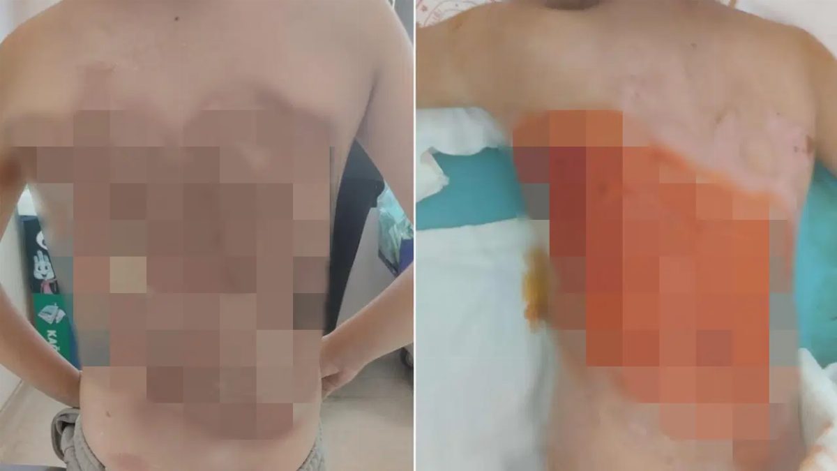 Arnavutköy'de Akran Zorbalığı: 12 Yaşındaki Çocuğun Sırtı Yandı