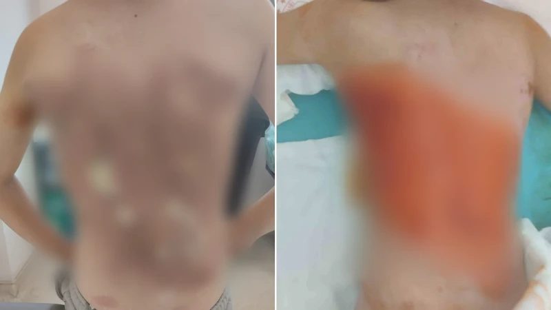 Arnavutköy'de Akran Zorbalığı: 12 Yaşındaki Çocuk Yandı